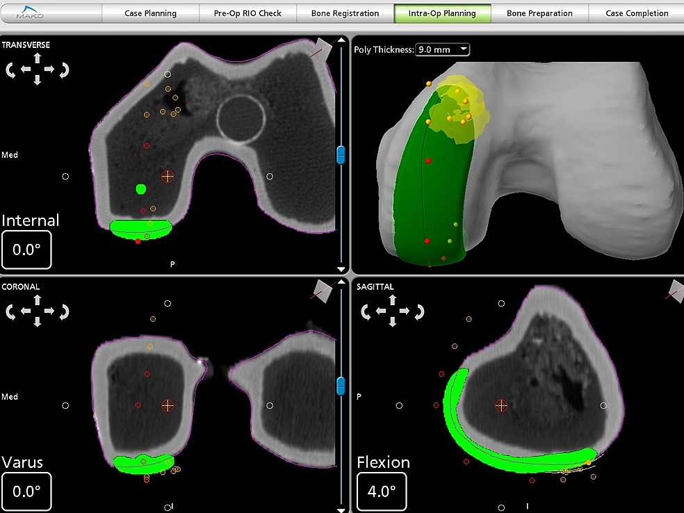 Computertomographie eines Kniegelenks