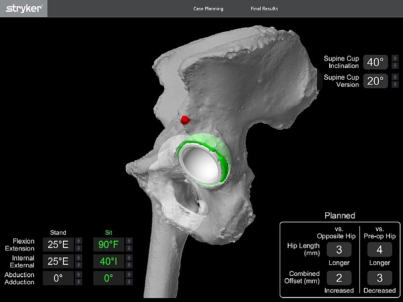 Bild eines Hüftgelenks mit Gelenkimplantat